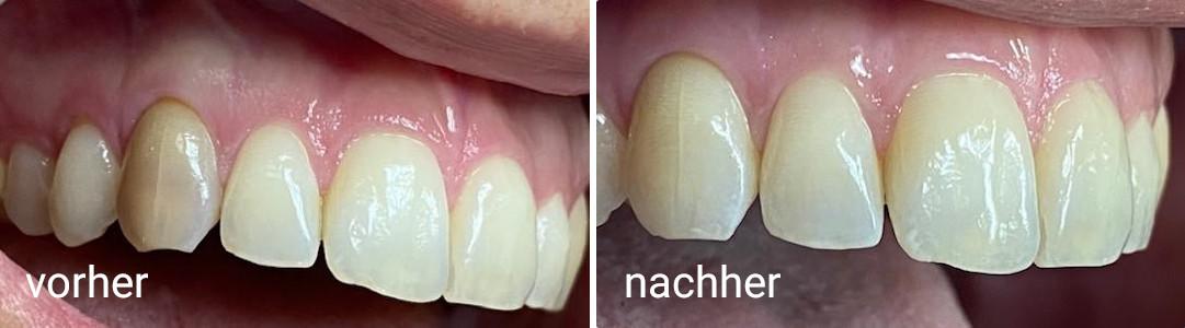 Bleaching vorher-nachher